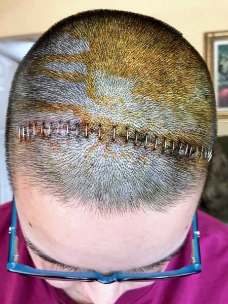 Top of 21 year old's shaved head with staples in it after brain surgery
