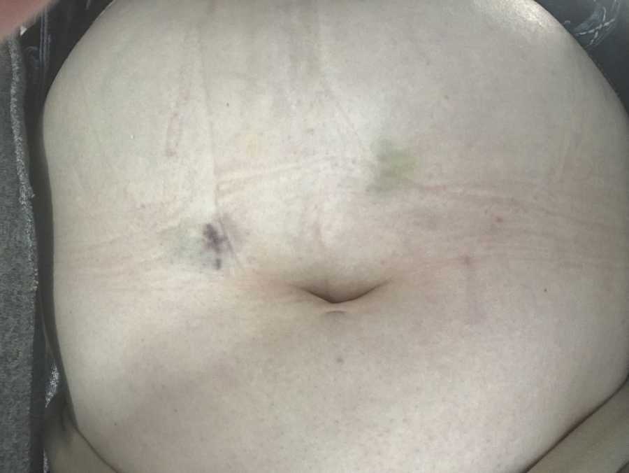 Woman's stomach with bruises on it from IVF injections