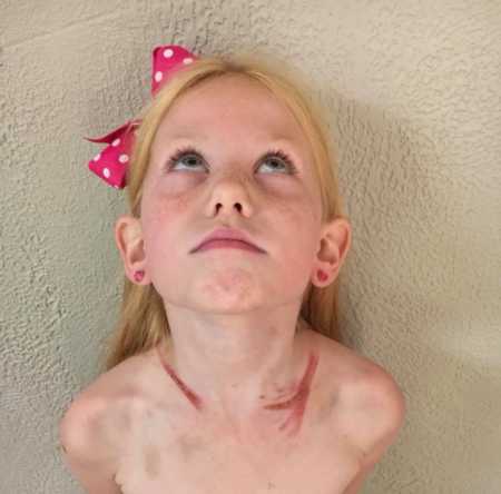 Little girl with red scars on both collarbones from car wreck