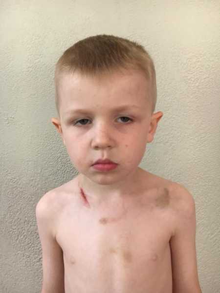 Young boy with scar on collarbone and bruises on body from car wreck