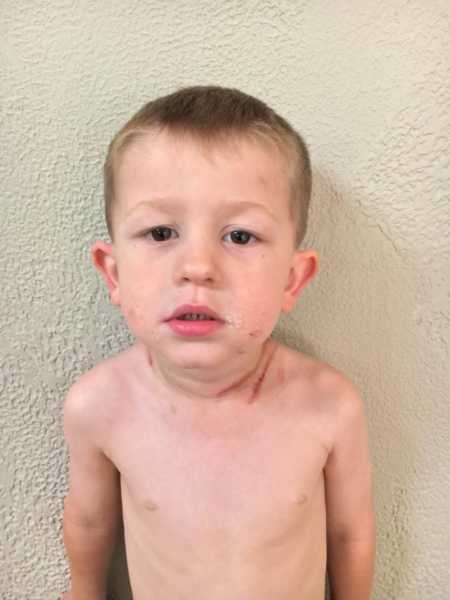 Young boy with red scars on shoulders from car crash