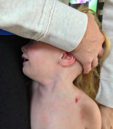 Young child with scar on neck from car crash