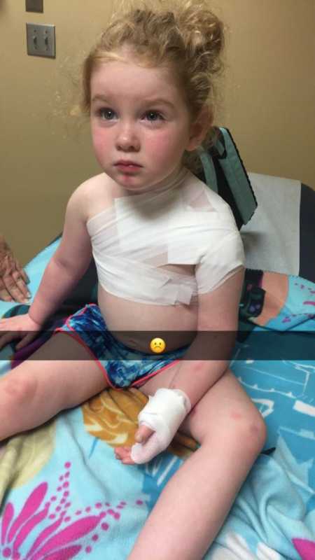 Toddler sitting up in doctors office with bandages on her hand and shoulder after skin graft