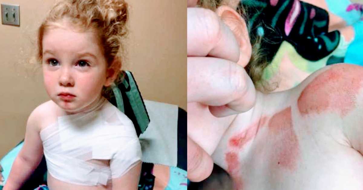 ‘I couldn’t get to her fast enough. I felt helpless.’: Mom warns of treadmill burn dangers after 3-year-old was caught between belt and wall