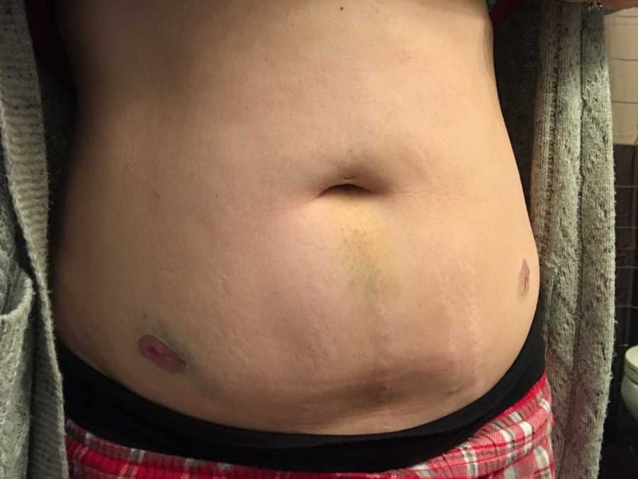 Woman who struggles with fertility's stomach with bruises on it from IVF injections