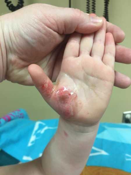 Burn on three year old's hand from getting caught between wall and treadmill