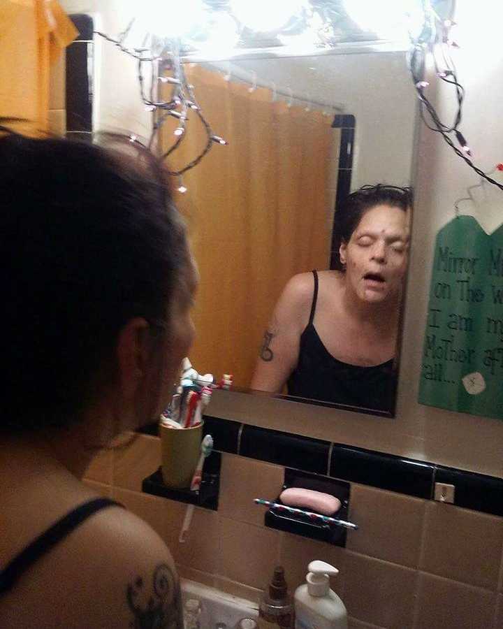 Drug addict in bathroom unconscious with sores on her face