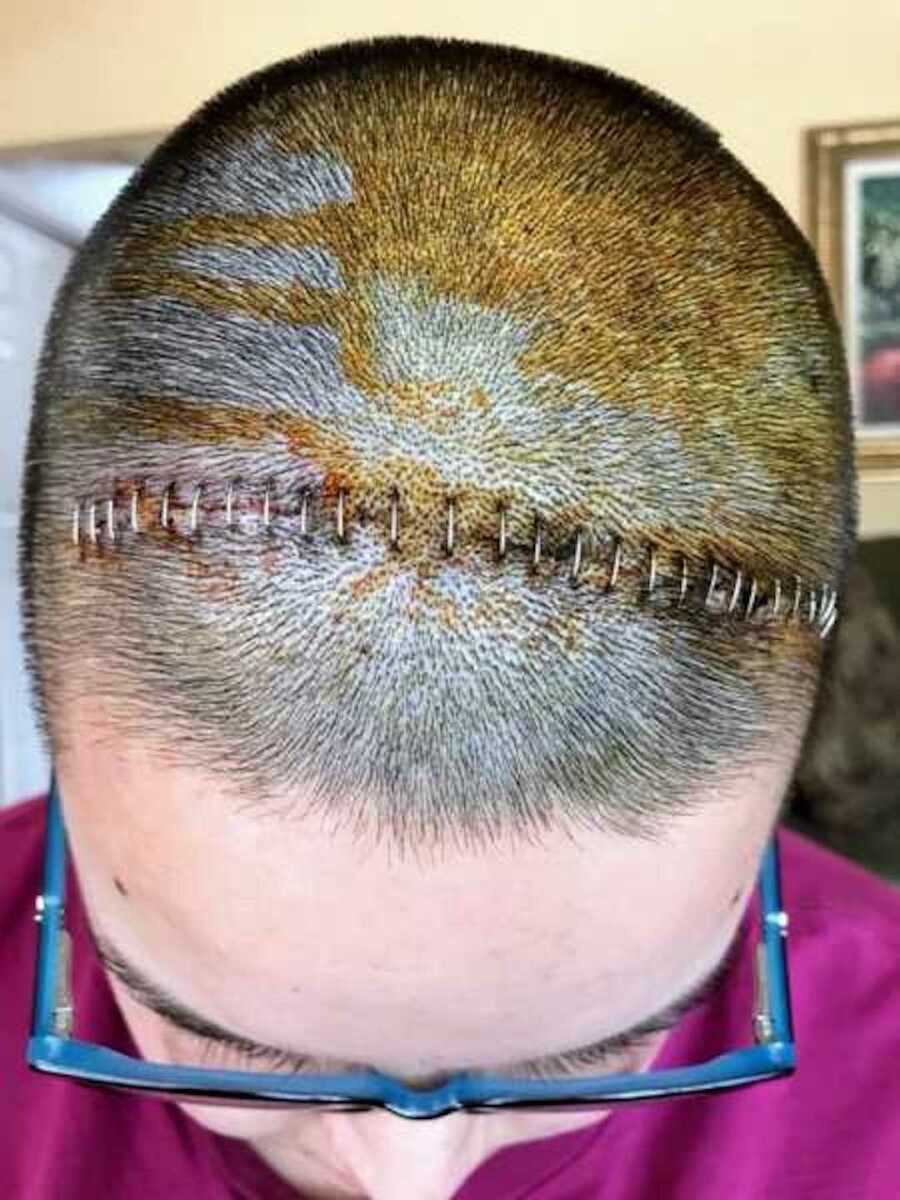 top of head after brain surgery