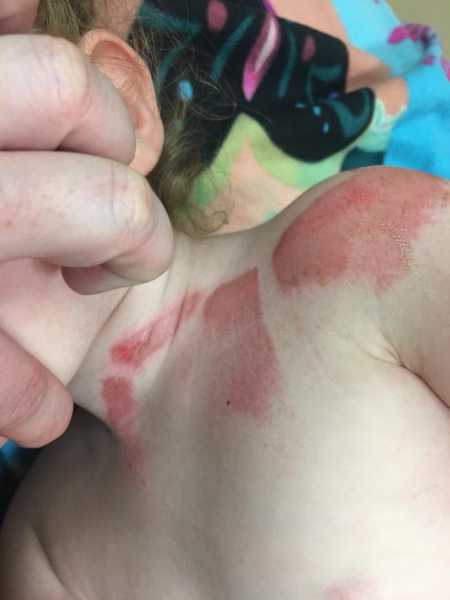 Three year old with burns on shoulder and neck from getting caught between wall and treadmill