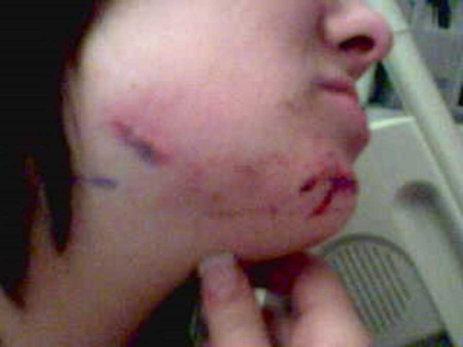 Bruises and scars on woman's chin after being shot in chin