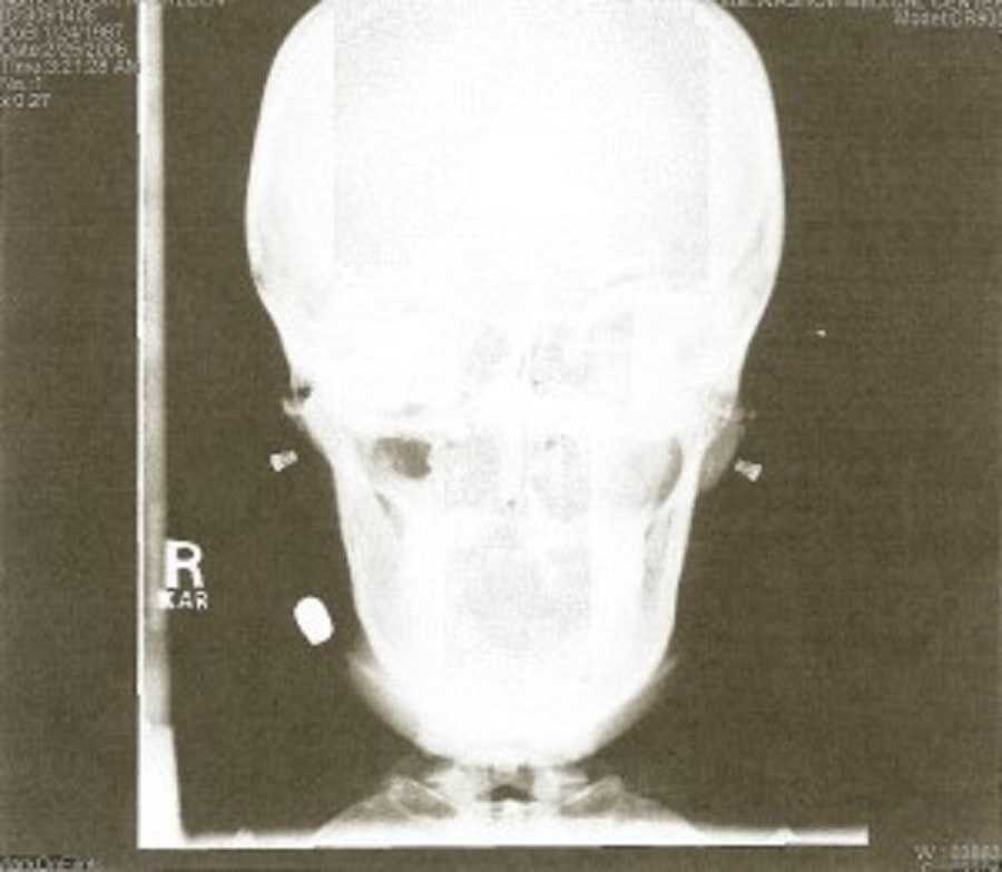 X-Ray of woman's head who was shot in chin