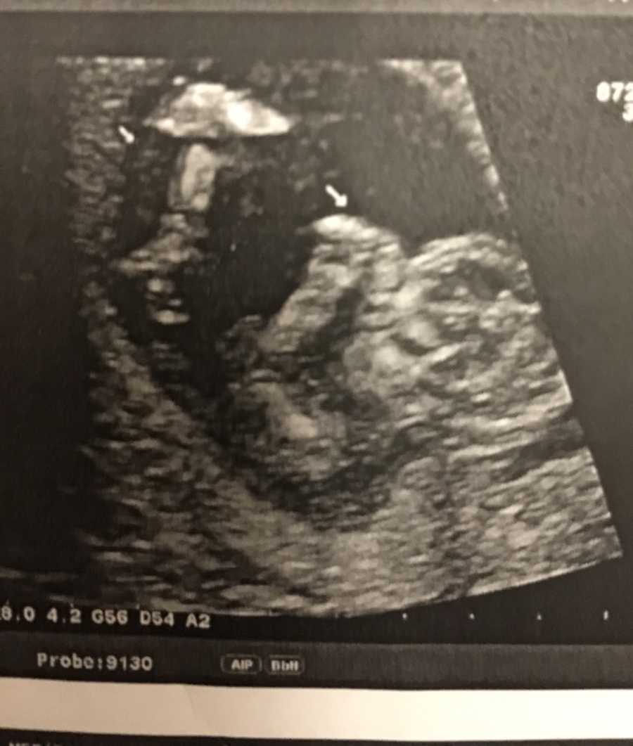 An ultrasound image of a baby in a pregnant mom's stomach