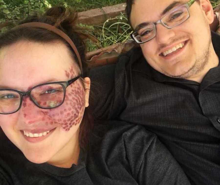 A woman with a port wine stain birthmark on her face and her partner lying on their backs outdoors.