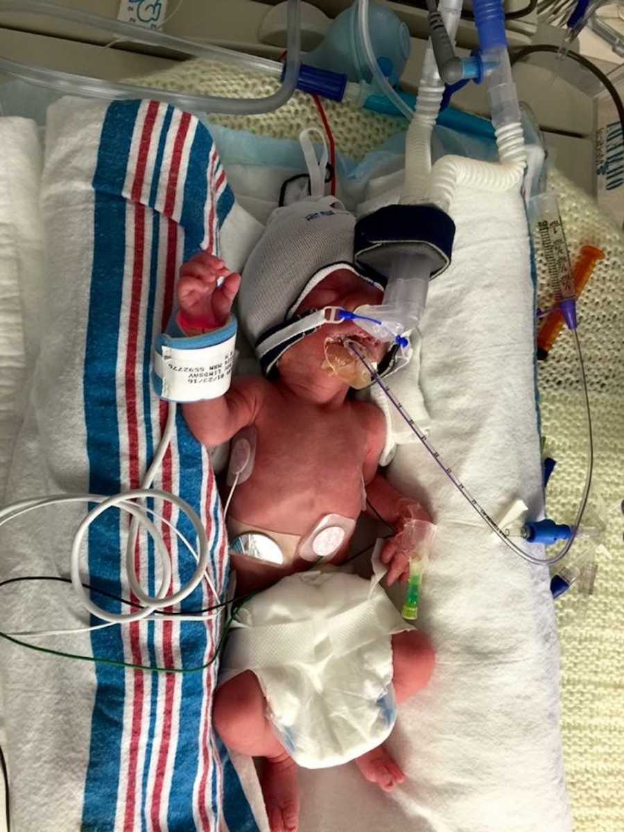 A newborn baby with a breathing tube hooked to their face, wearing a large diaper.