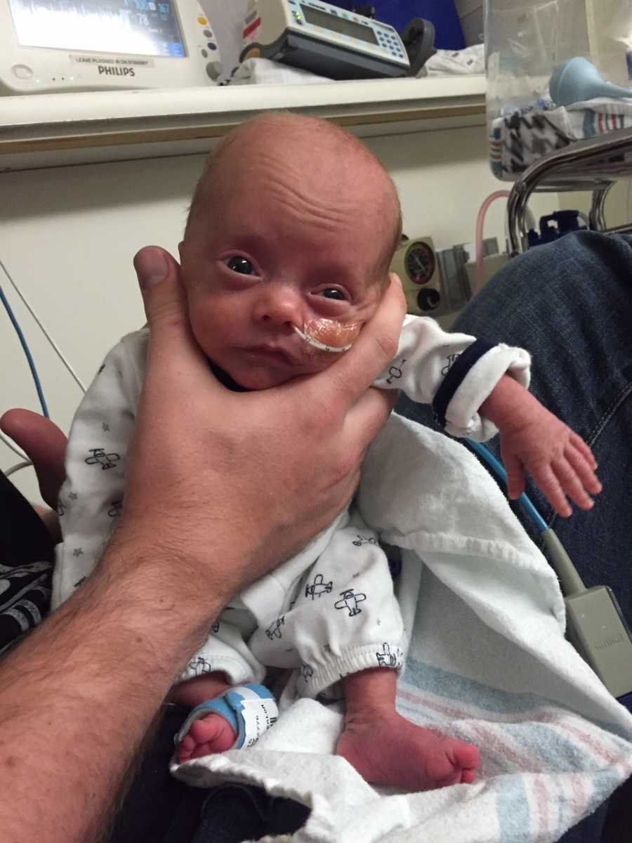 A young baby wearing a white and black onesie with a feeding tube hooked to their nose.