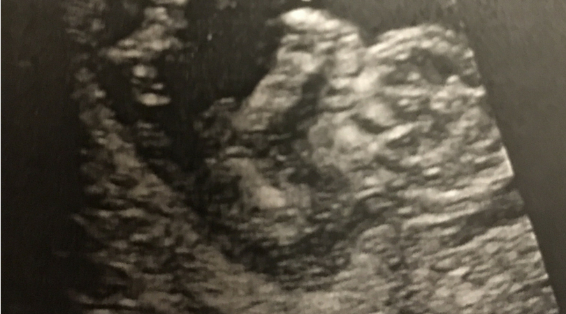 An ultrasound of a baby in its mom's stomach