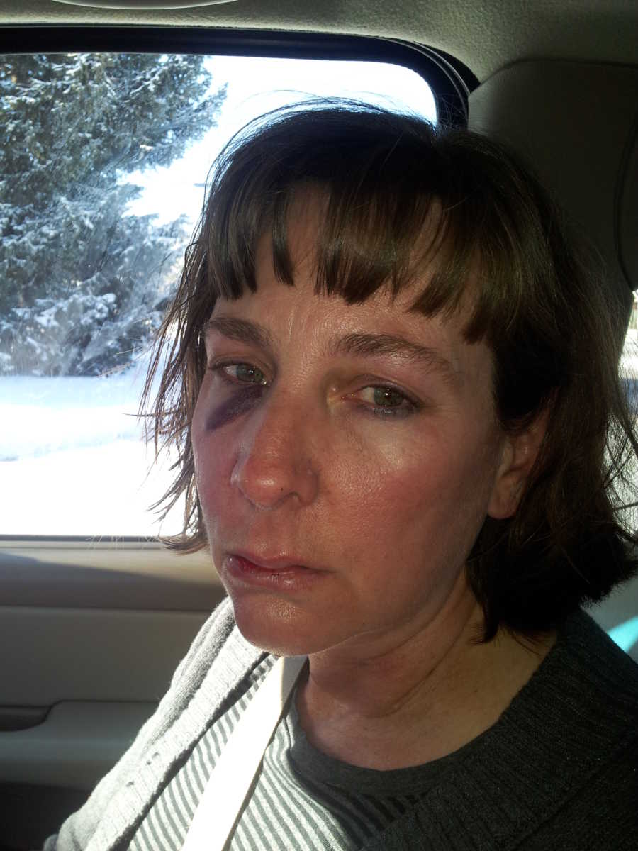 Woman looks to be in pain with a black eye and bruised lips