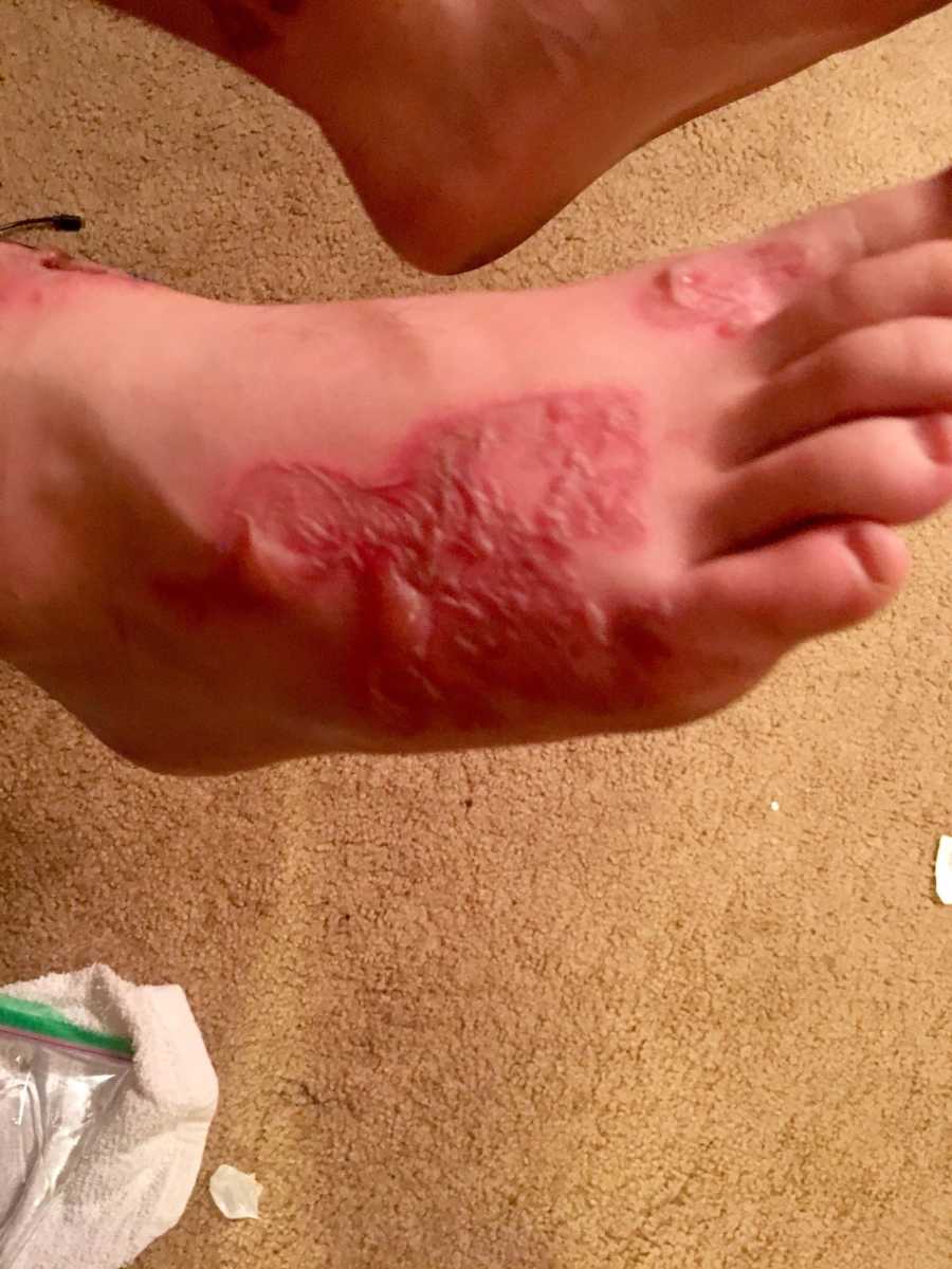 Teen boy suffering from infection takes photo of his foot with red sores on it