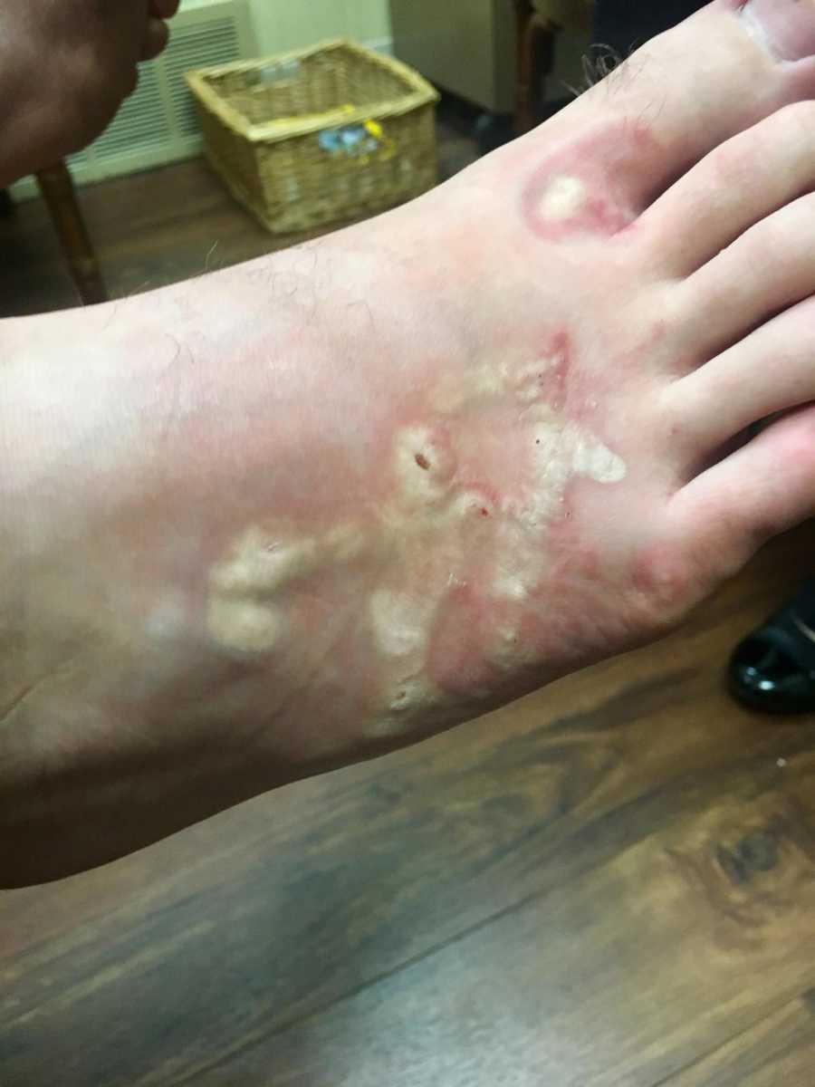 Teen boy infected with hook worms has sores, blisters on his foot
