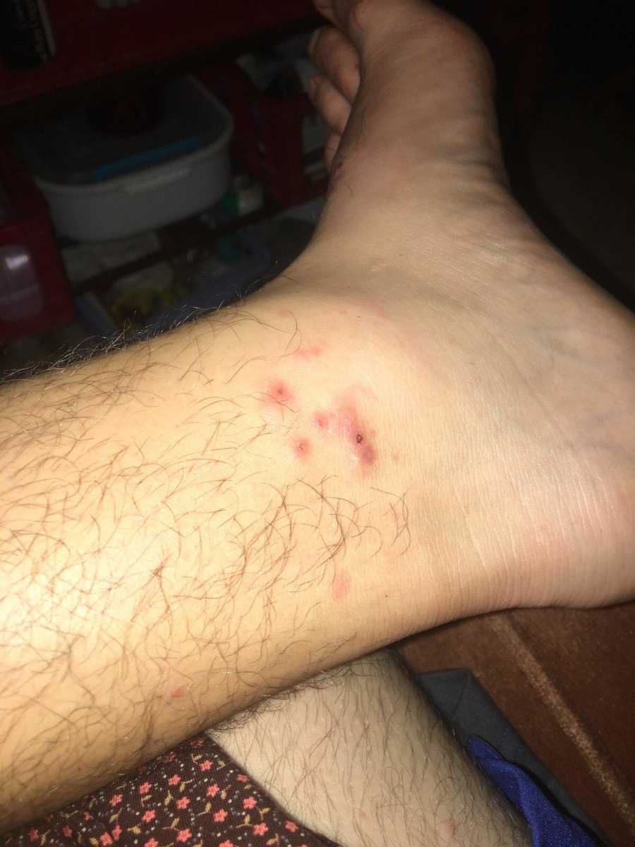 Teen boy snaps a photo of an infection spreading on his ankle