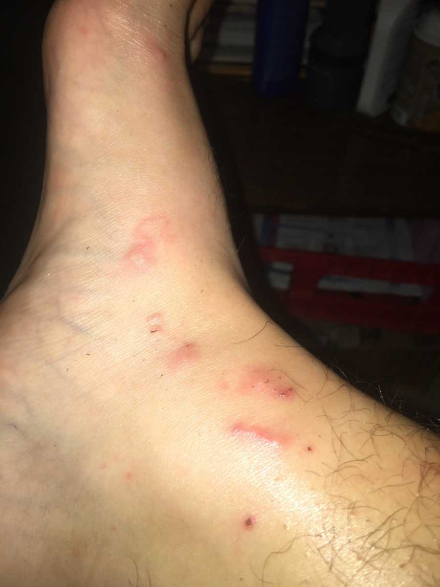 Teen boy snaps a photo of bites on his ankle and foot