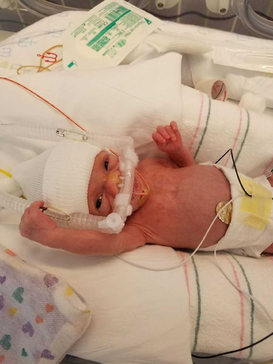 Mom takes a photo of her newborn baby in the NICU with tubes stuck in his nose