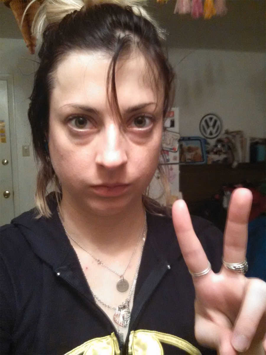 Woman battling alcoholism takes a selfie while doing the peace sign with severe bags under her eyes