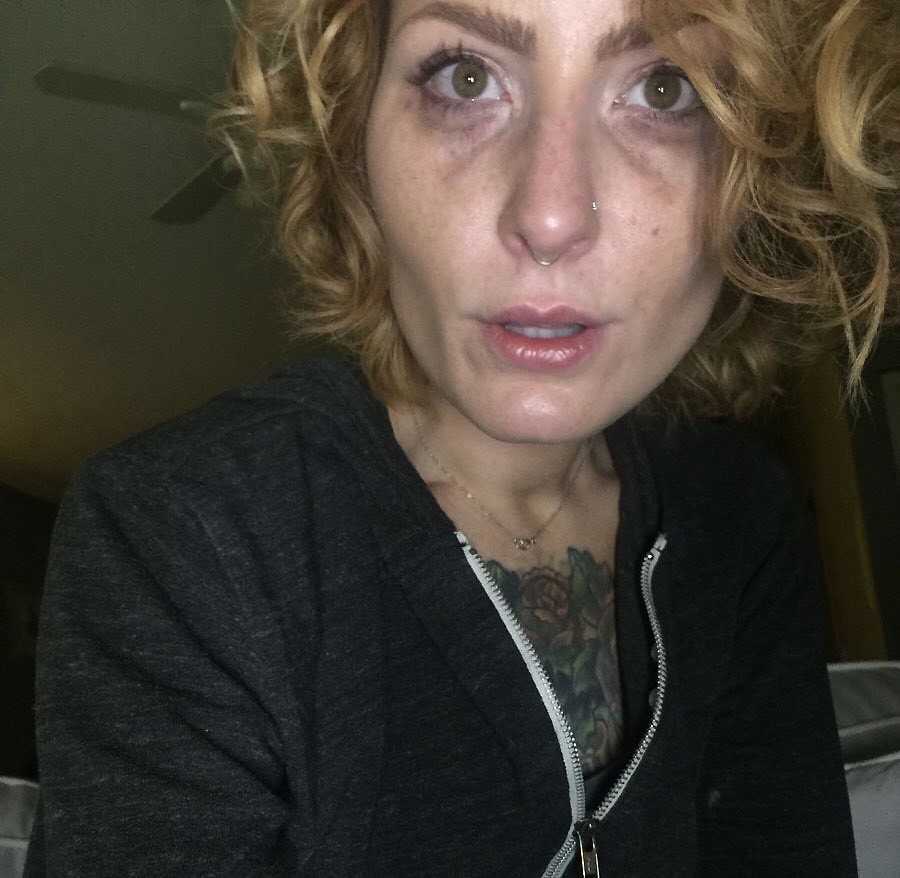 Woman in active addiction takes a selfie, showing the bags and bruises under her eyes