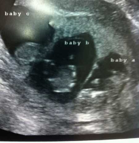 Woman takes photo of ultrasound revealing she is expecting triplets