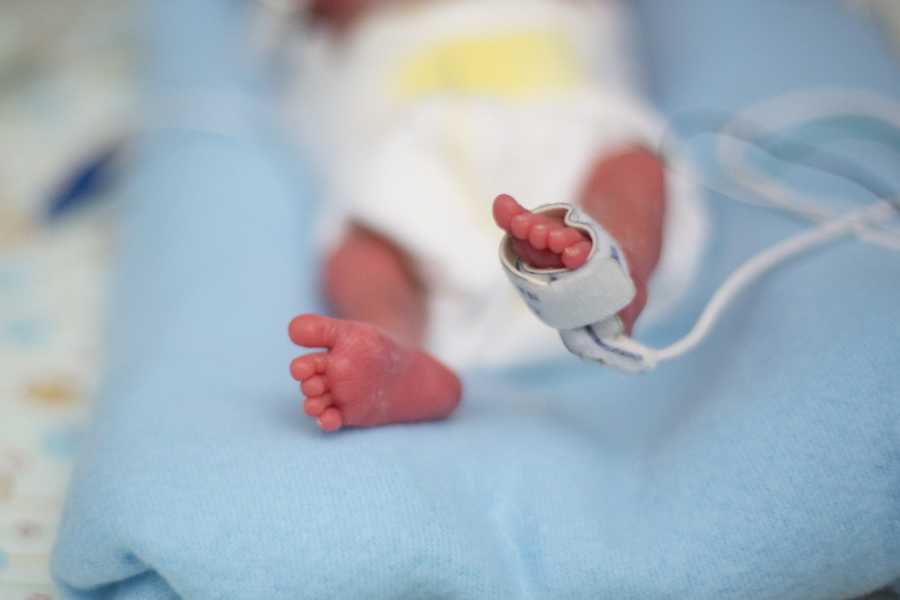 Tiny foot of newborn with wire wrapped around his foot who won't live long