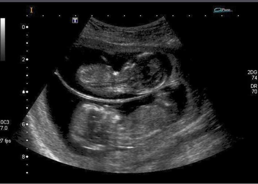 Ultrasound of twins