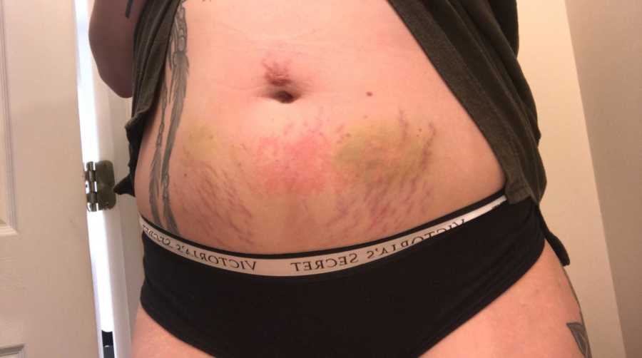 Stomach of woman who recently gave birth with red spots and bruises