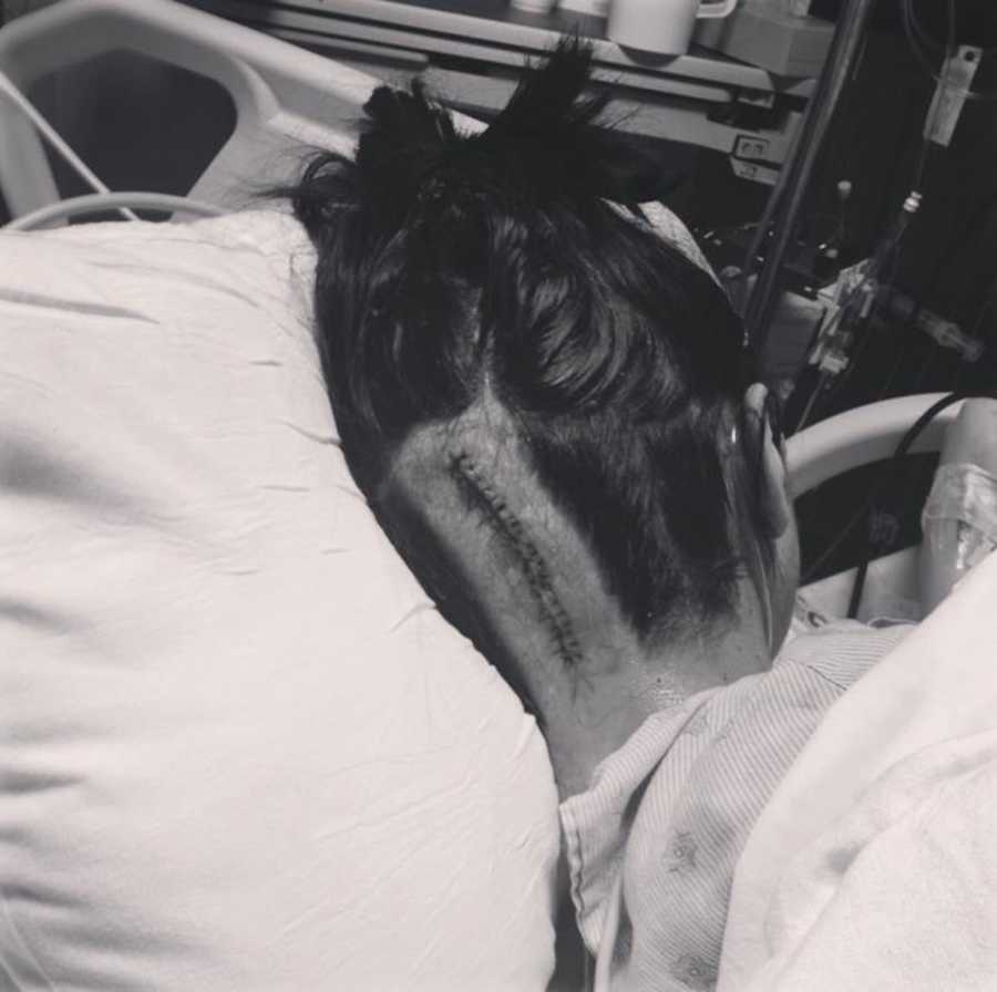 Woman with Chiari Malformation lays on side in hospital with stables down back of her head after brain surgery