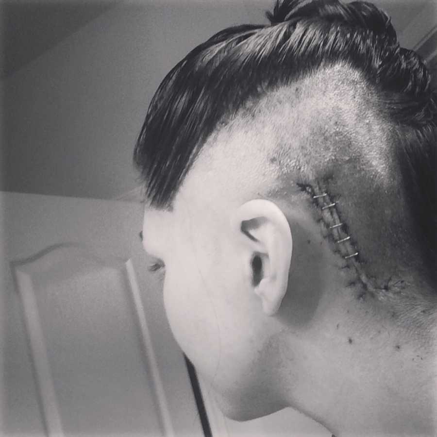 Shaved head of woman diagnosed with Chiari Malformation with staples on her head after brain surgery