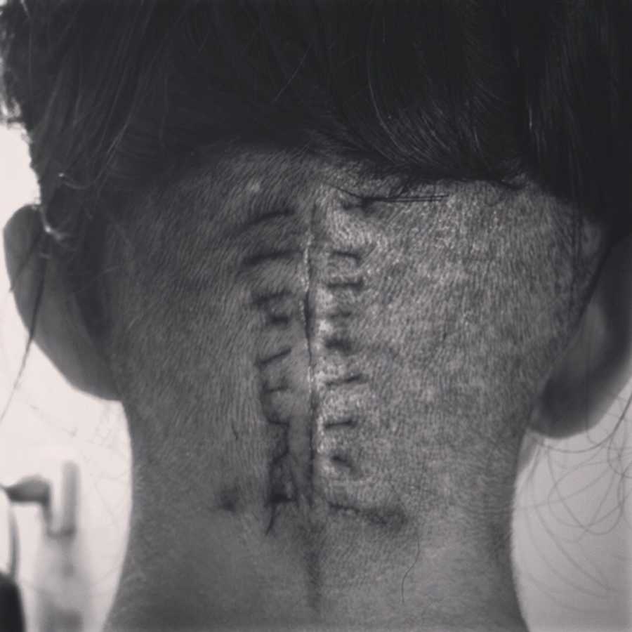 Close up of woman's shaved head with staples in it after brain surgery