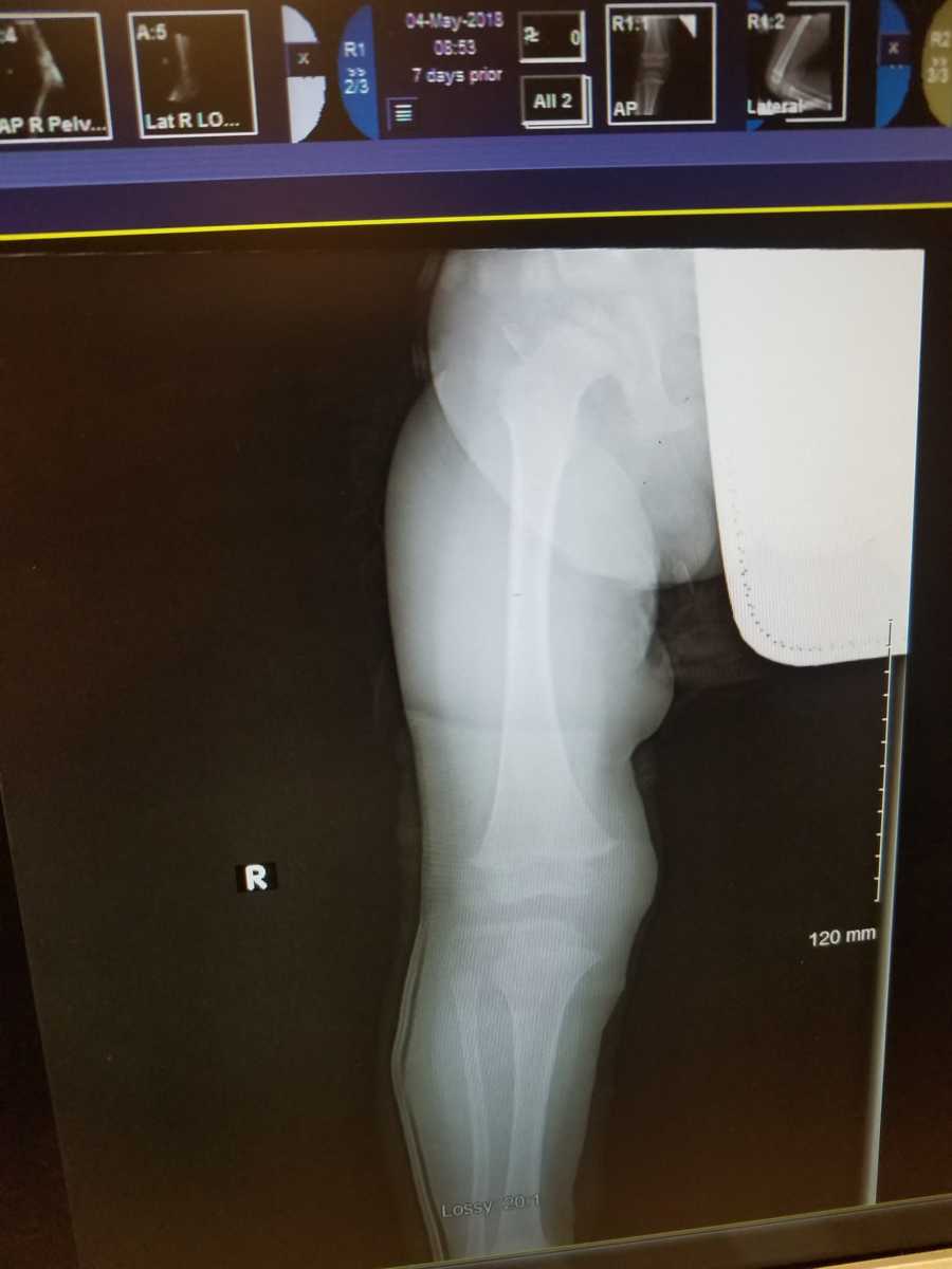 X-ray of young boy's leg who doctor's couldn't figure out what was wrong with