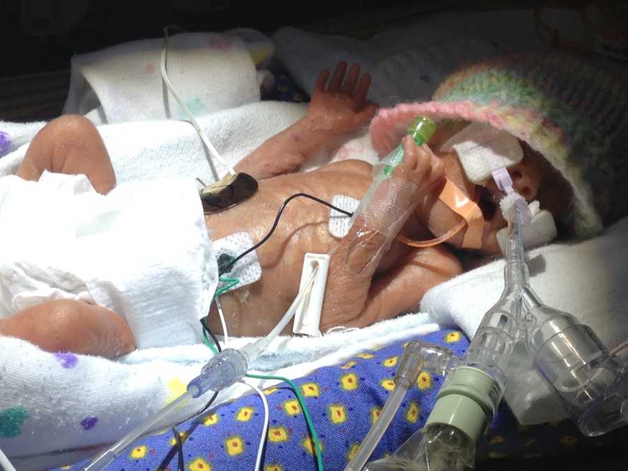Premature baby sleeping in NICU with wires attached to her body 