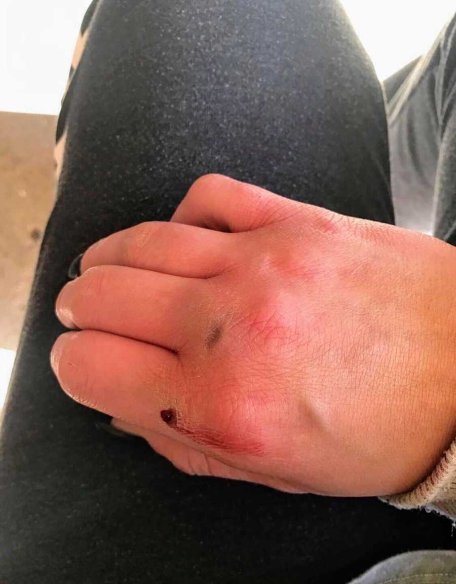 Wife's hand with scars on them from defending herself from husband