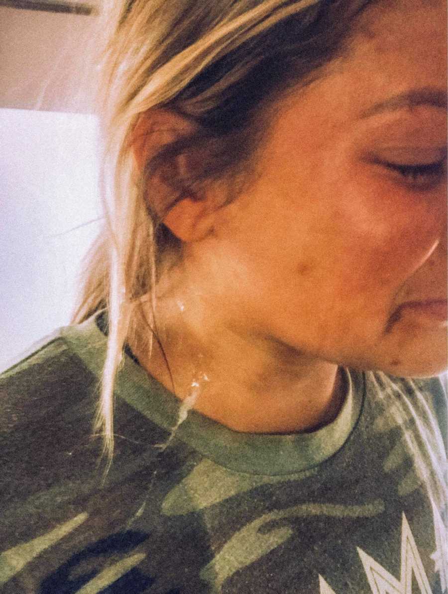Wife with bruises on her face from husband