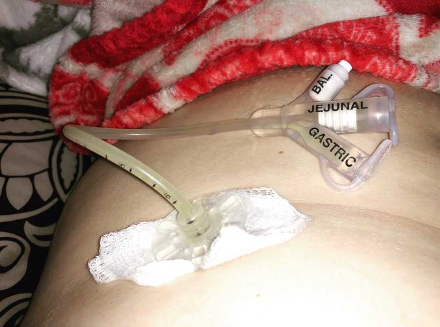 Feeding tube attached to teen's stomach who has Gastroparesis
