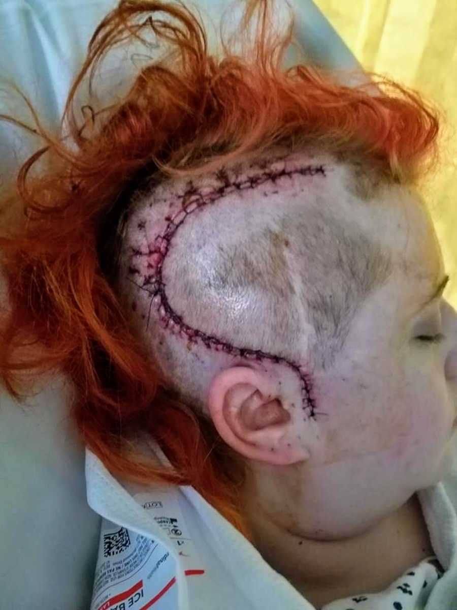 Woman with epilepsy's shaved head with stitches after second brain surgery