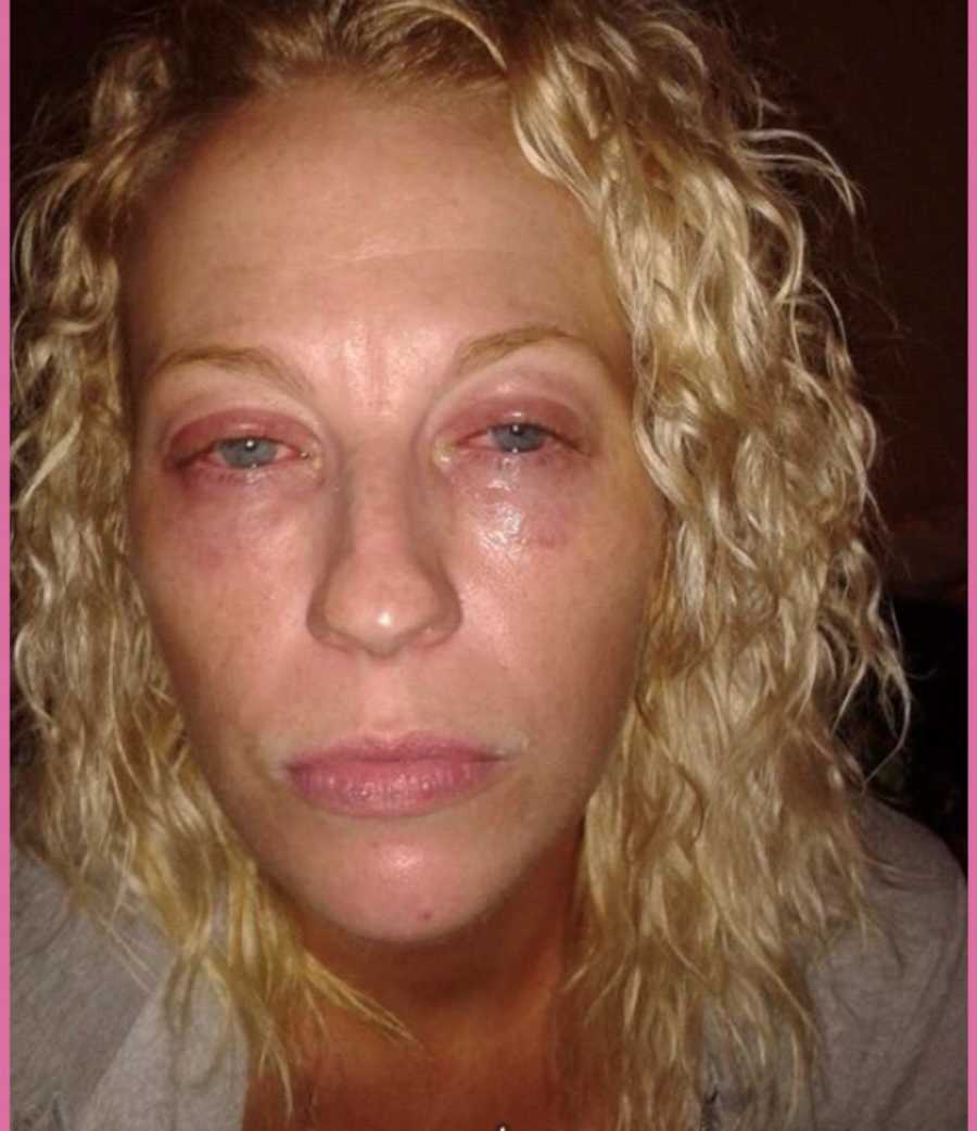 Woman who was a drug addict's eyes that are red and puffy