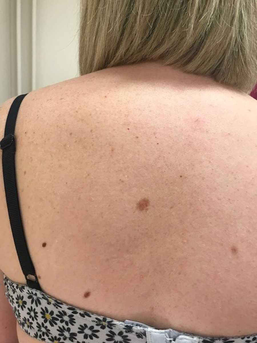 Cancerous mole on woman's back that needed to be removed