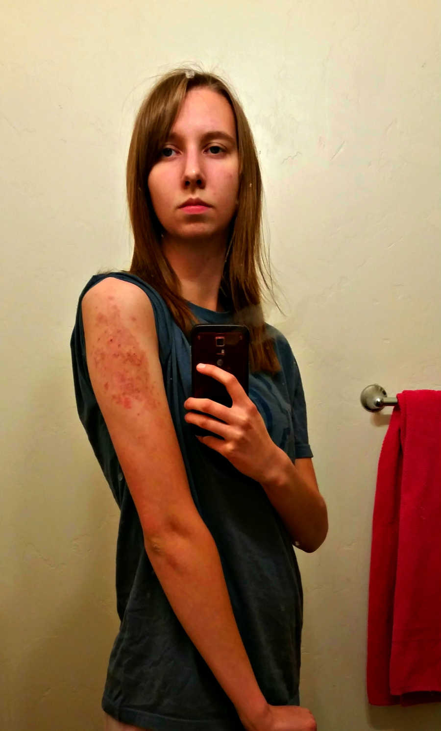 Teen takes mirror selfie showing rash on her arm
