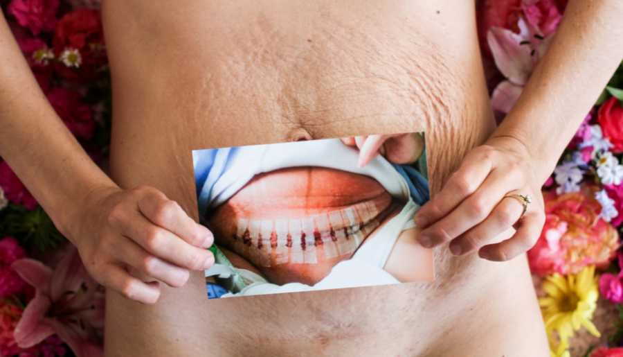 Woman who had c-section holds up photograph of her scars over her stomach