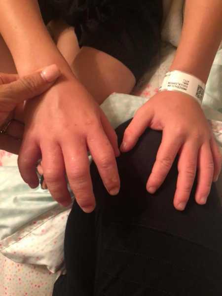 Hands of little boy that are swollen from citrus burn
