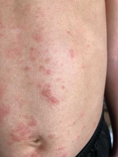 Stomach of little boy with red spots all over it from citrus burn