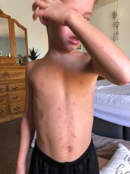 Shirtless little boy with red spots all over his stomach stands wiping his tears 
