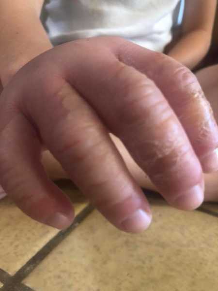 Swollen and scabbed fingers of little boy who has citrus burn