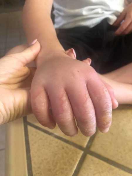 Mother holds hand of son who has citrus burn